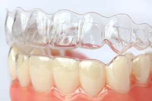clear aligners atop a set of artificial teeth