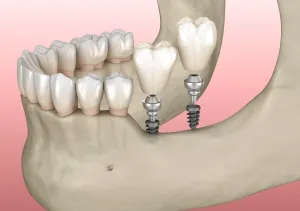 CGI dental implant placement